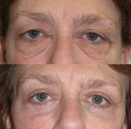 下眼睑的衰老变化