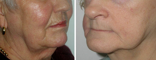 下面部明显下垂颈部皱纹增多