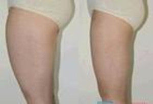 大腿吸脂减肥效果图