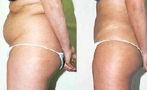 腹部吸脂减肥效果图