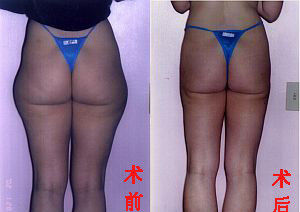 臀部吸脂减肥效果图