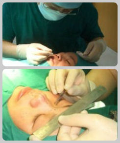 注射隆鼻前消毒和划线。