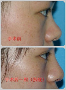 注射隆鼻效果对比图