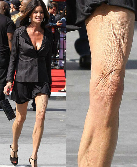 珍妮丝-狄金森双腿皮肤如老树皮