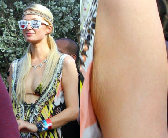 帕丽斯-希尔顿的手臂惊现皱纹