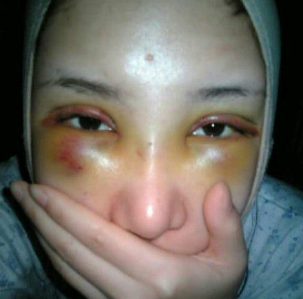 拆了重磅包扎，还是很肿的一张脸。