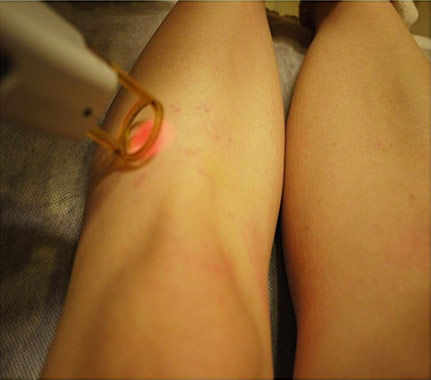 镭射中，感觉不是很疼。