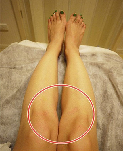 镭射后出现的小红点。