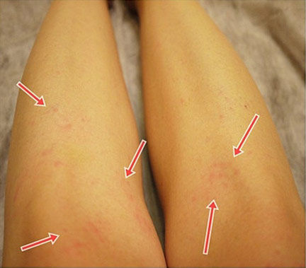 小红点的部位有些刺痛感。