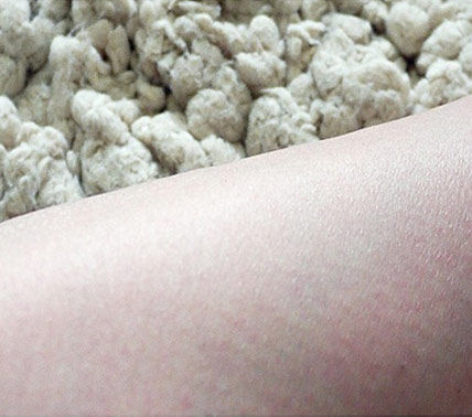 镭射后，皮肤变得干燥。