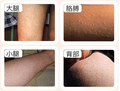 传说中的“鸡皮肤”。
