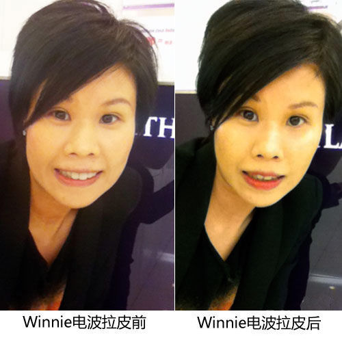 电波拉皮三个月后对比图