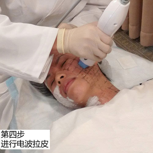 电波拉皮治疗中