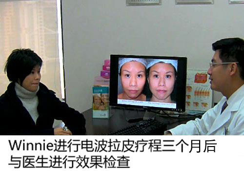 电波拉皮3个月后的复诊