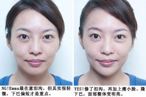 泪沟填充效果对比图(正面)泪沟填充效果对比图(侧面)