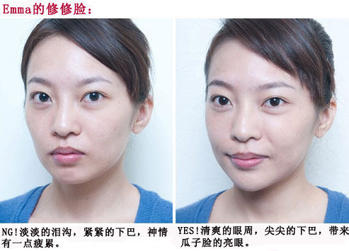 泪沟填充效果对比图(侧面)