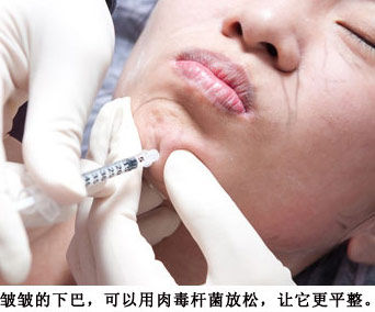 肉毒素帮助去除下巴上的皱纹。