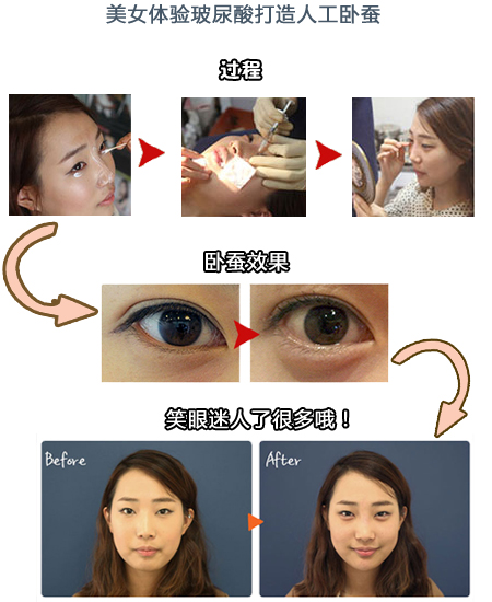 玻尿酸做卧蚕的过程