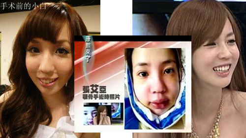 小白颚骨整形后对比图