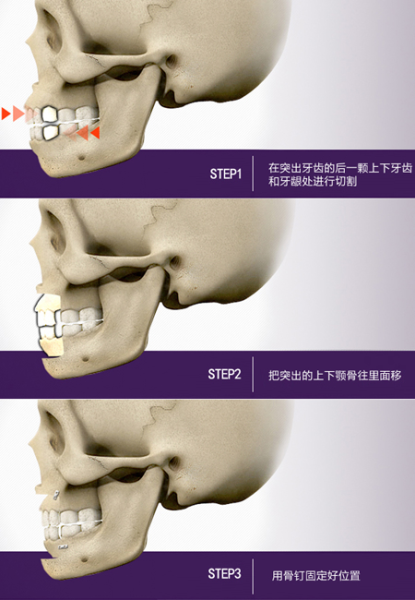 双颚骨整形手术简单示意图