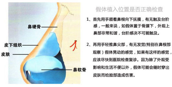 如何检查假体位置是否正确