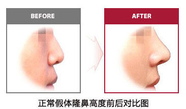 假体隆鼻效果示意图