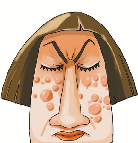 杭州女孩13万治青春痘。