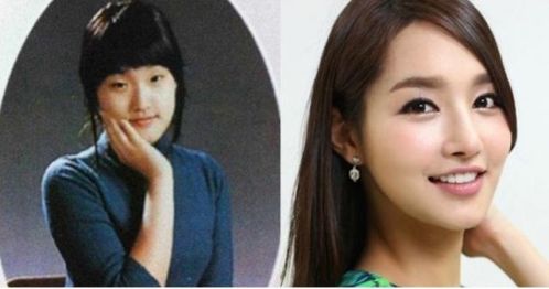 (金有美整形前后对比照)