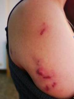 埋线减肥，满身脓包。