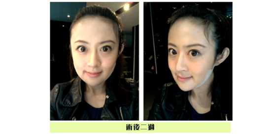术后2周效果图 