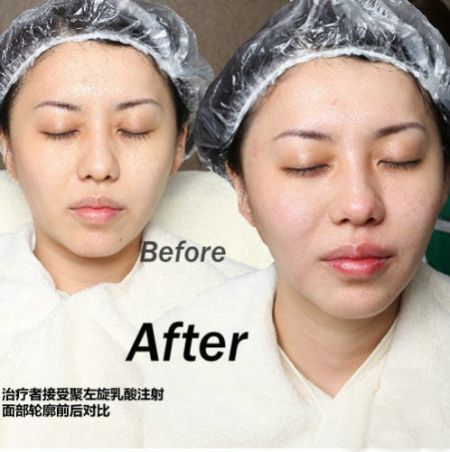 “针”出苹果肌，让人看起来更年轻。