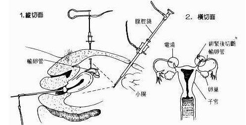 什么是女性结扎手术