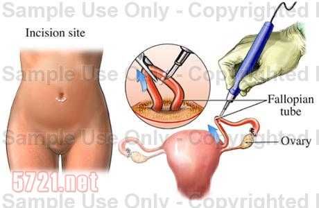 什么样的女性可以做结扎