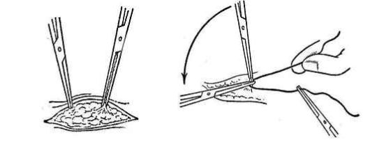 结扎手术有什么副作用
