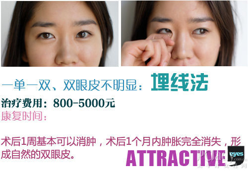 埋线法双眼皮术