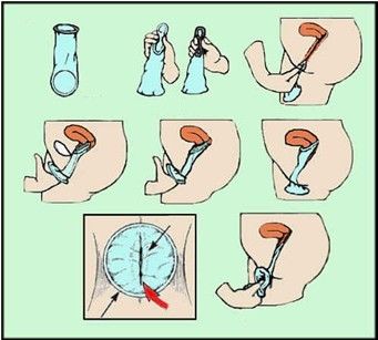 “女用避孕套”示意图