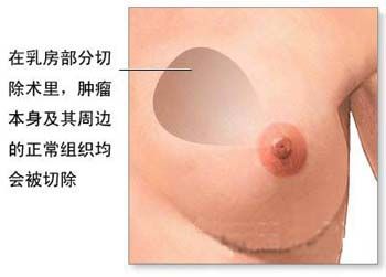 乳房切除术主要用于切除肿瘤组织