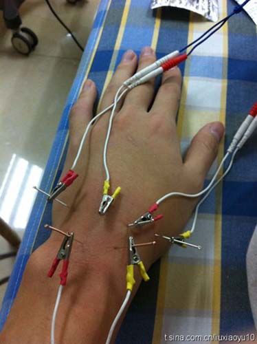 刘晓宇治疗手腕