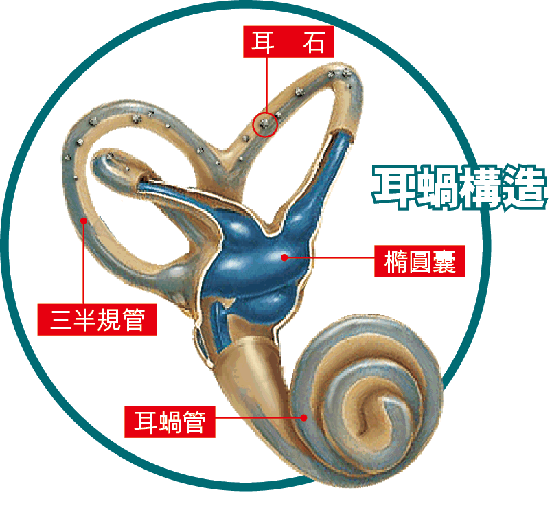 戴伊患上的是“耳石症”
