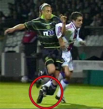 拉尔森的腿严重变形