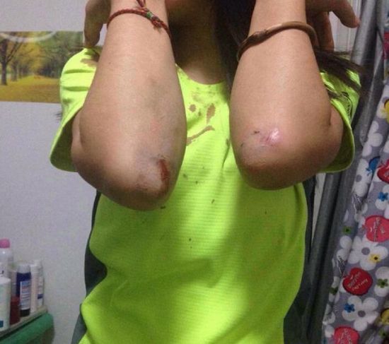 女跑友向警方展示自己的伤处。