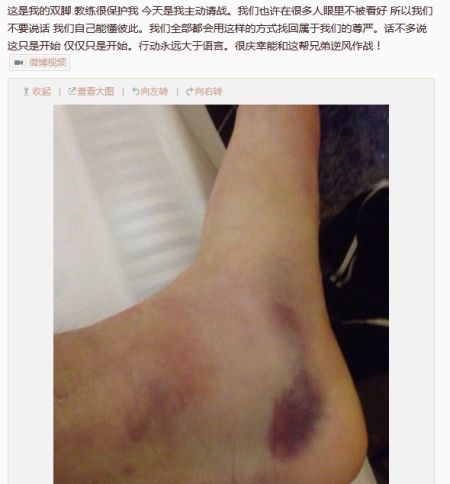 张修维脚部淤青照片