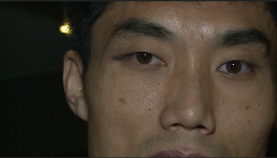 郑智眼角仍然瘀青